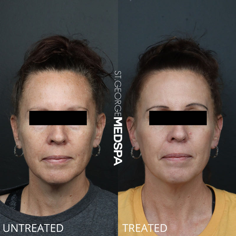 Pigment Correction Before & After Image