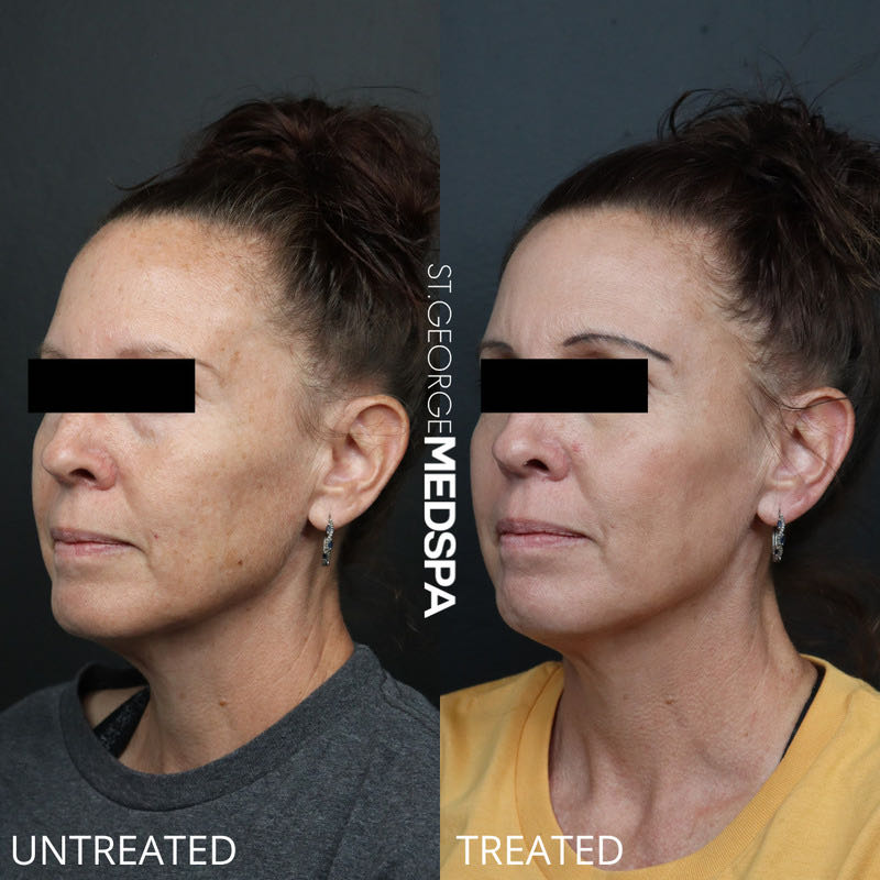Pigment Correction Before & After Image