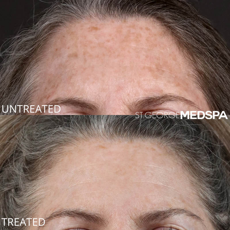 Pigment Correction Before & After Image