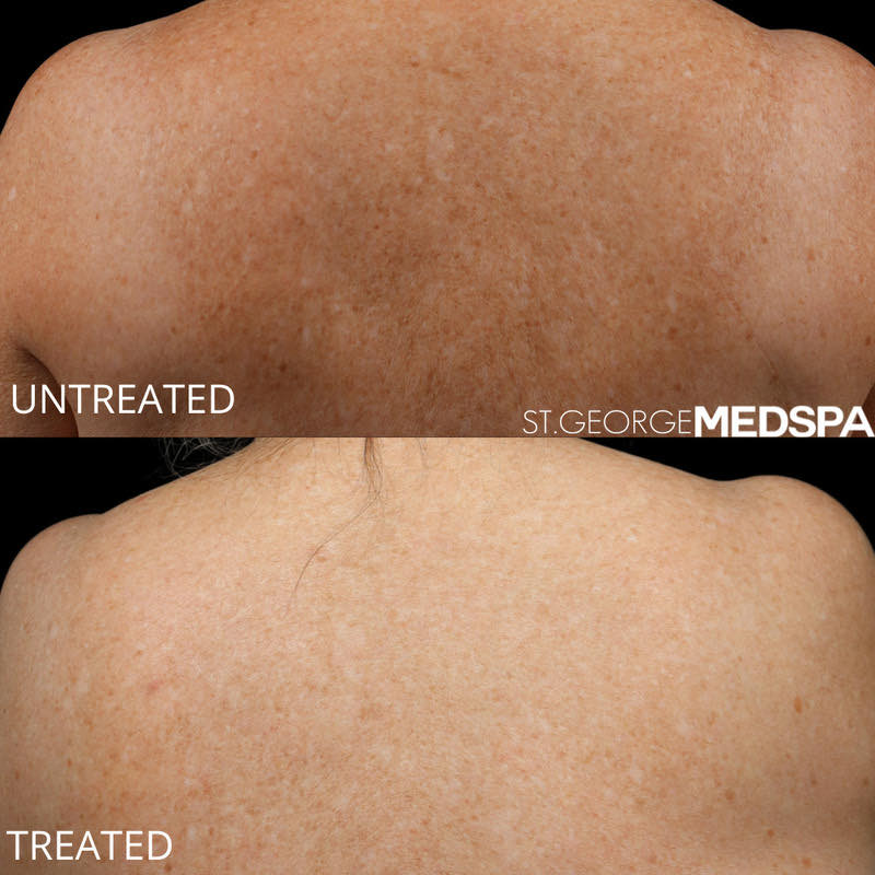 Pigment Correction Before & After Image