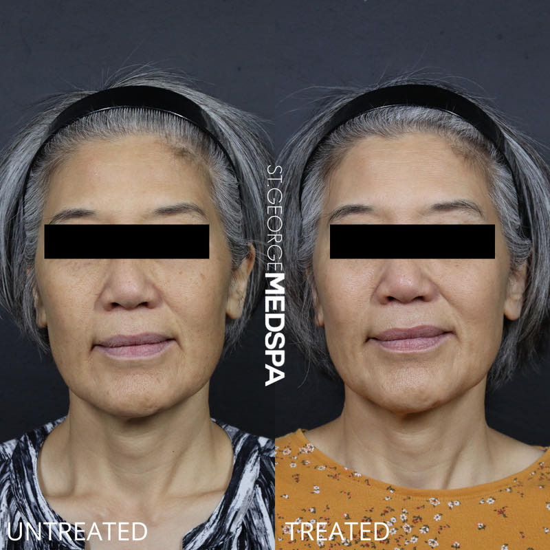 Pigment Correction Before & After Image