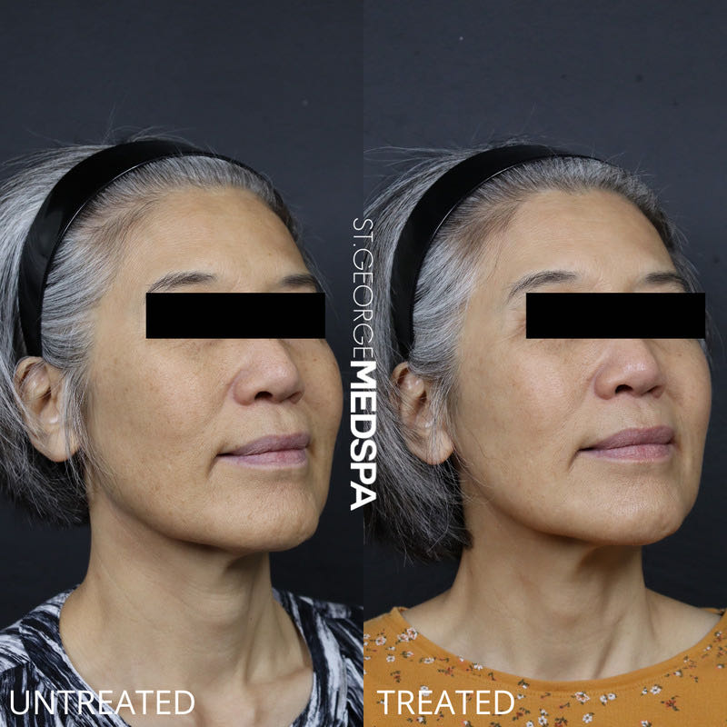 Pigment Correction Before & After Image