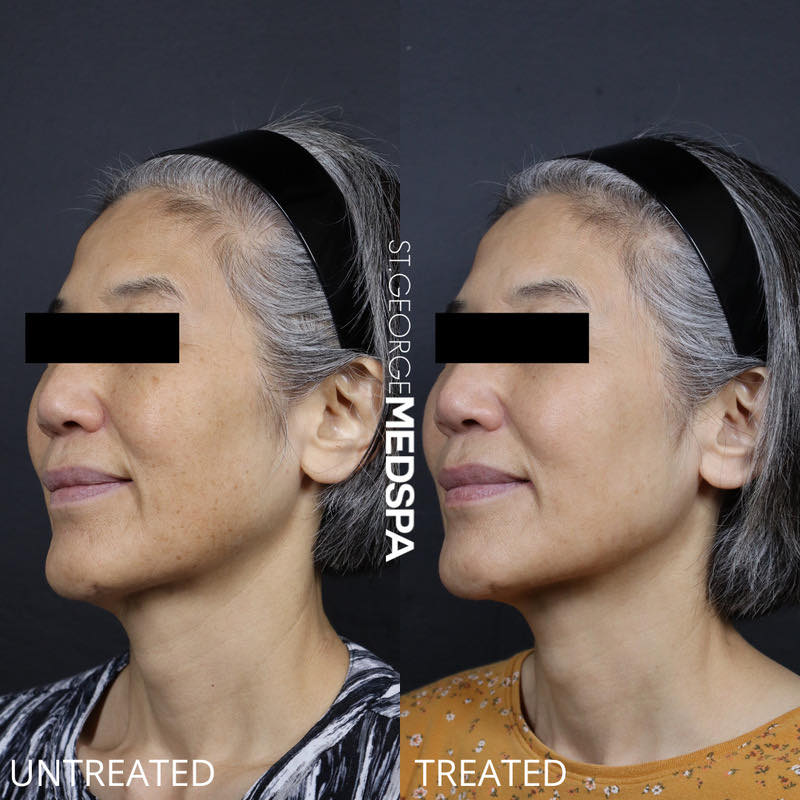Pigment Correction Before & After Image