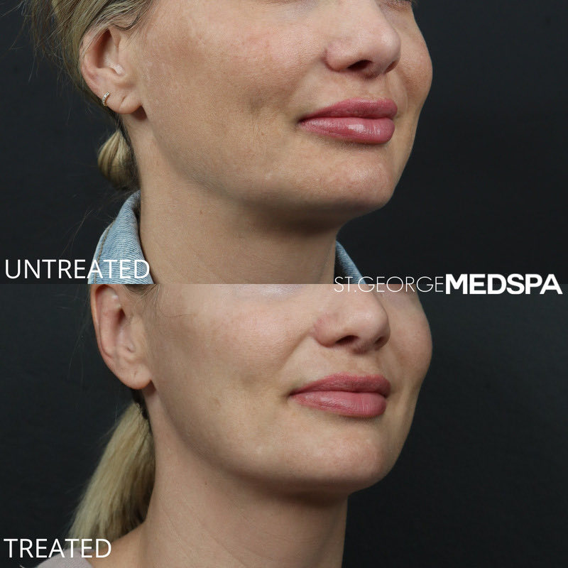 Pigment Correction Before & After Image