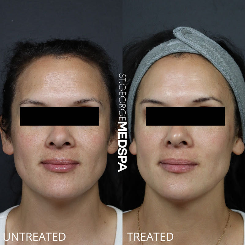 Pigment Correction Before & After Image