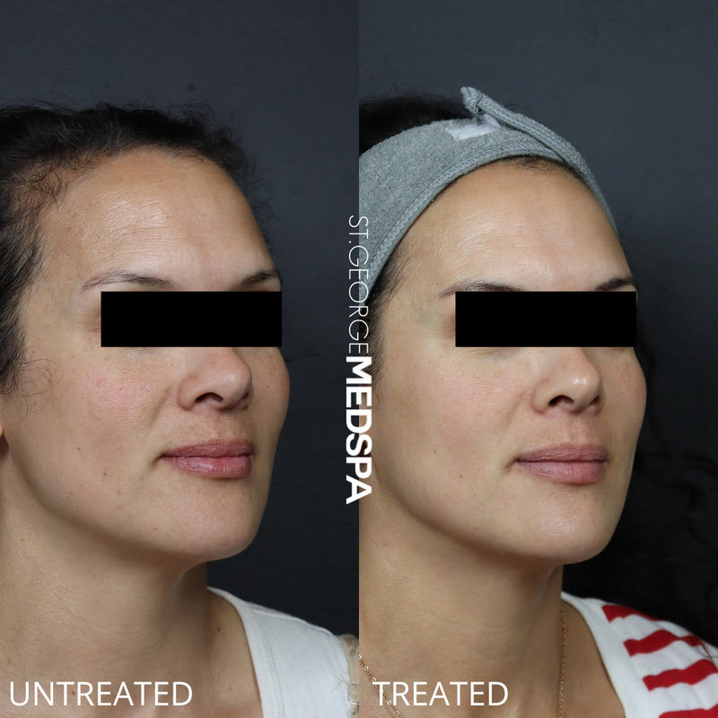 Pigment Correction Before & After Image