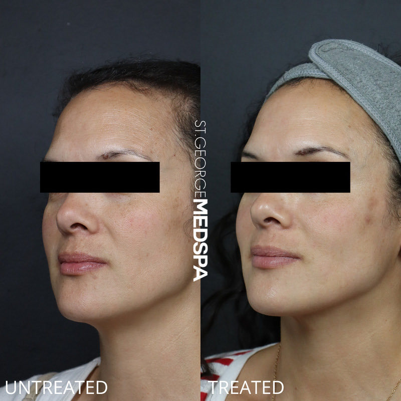 Pigment Correction Before & After Image