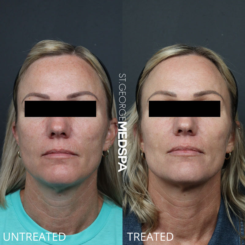 Pigment Correction Before & After Image