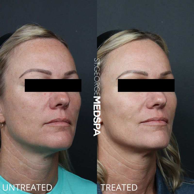 Pigment Correction Before & After Image