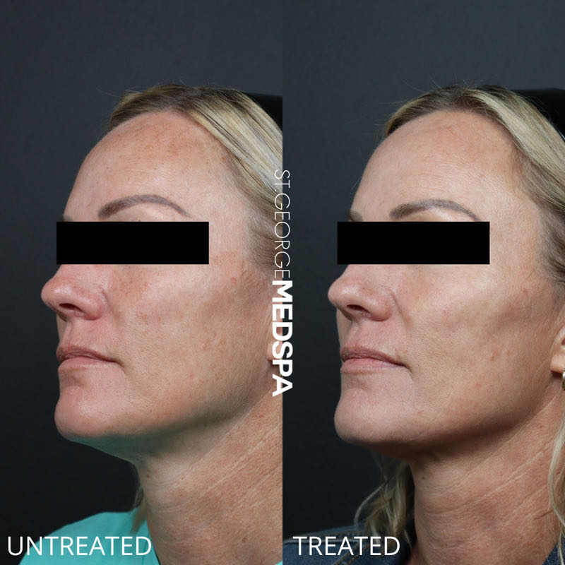 Pigment Correction Before & After Image
