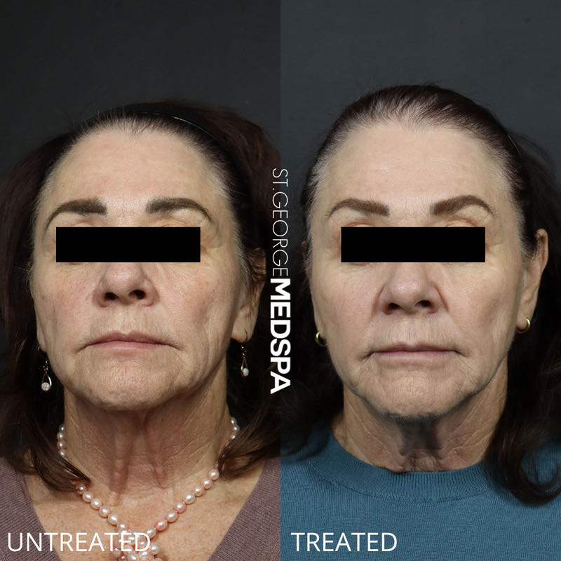 Pigment Correction Before & After Image