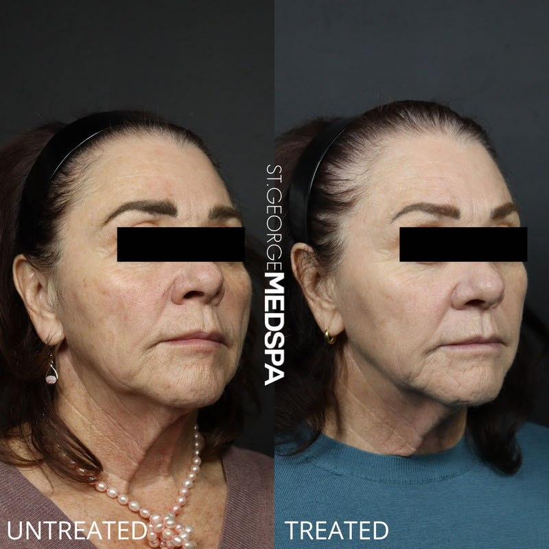 Pigment Correction Before & After Image