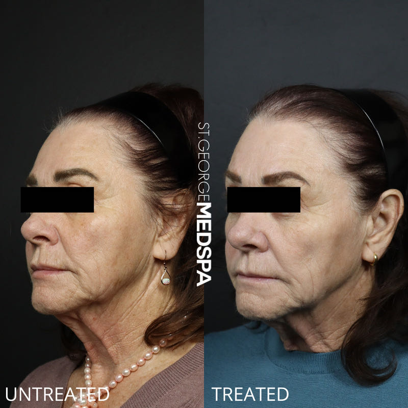 Pigment Correction Before & After Image