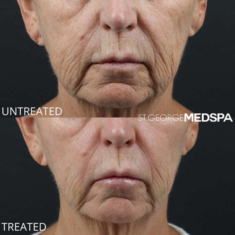 Skin Tightening Before & After Image
