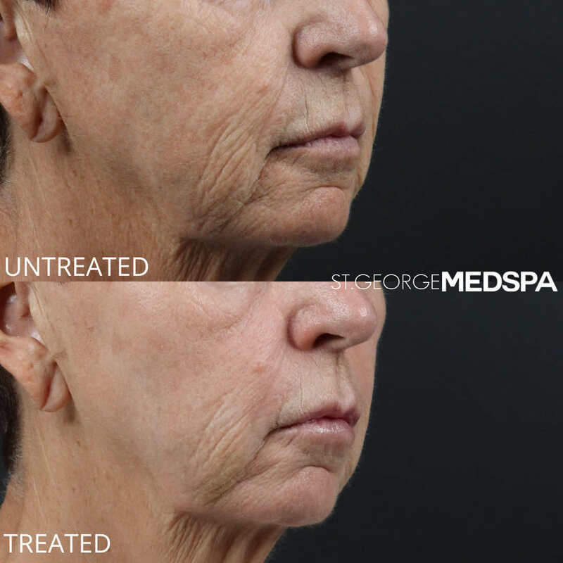 Skin Tightening Before & After Image