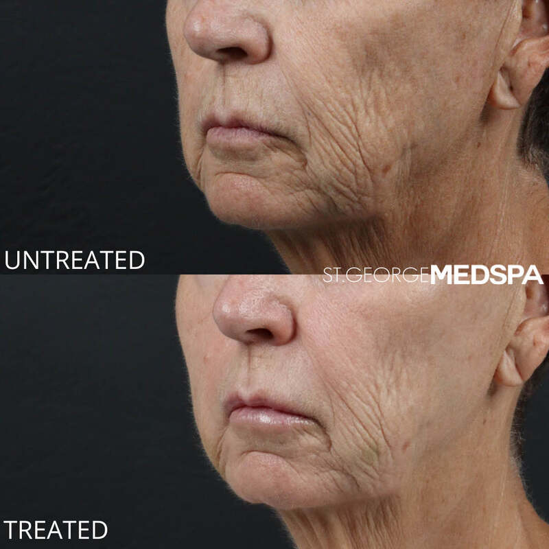 Skin Tightening Before & After Image