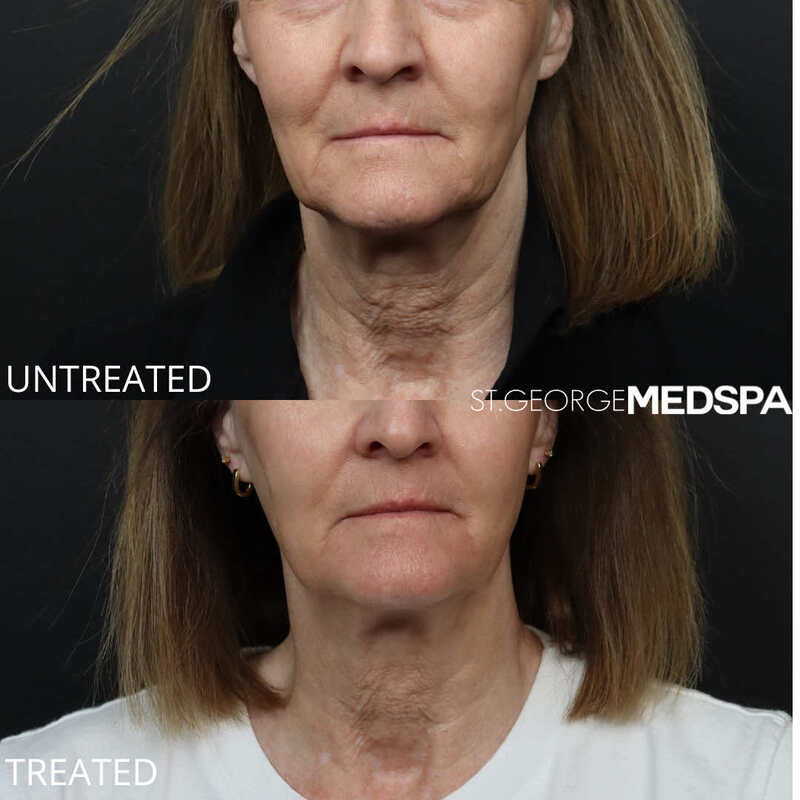 Skin Tightening Before & After Image