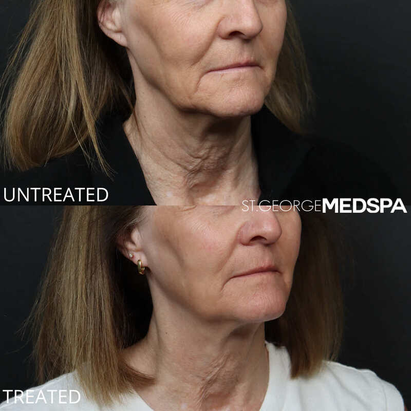 Skin Tightening Before & After Image