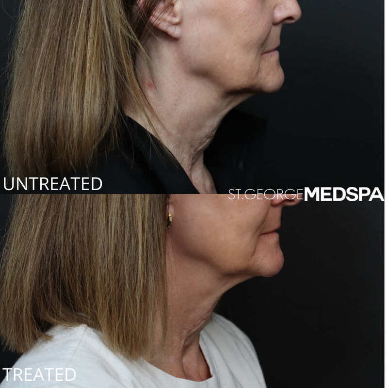 Skin Tightening Before & After Image