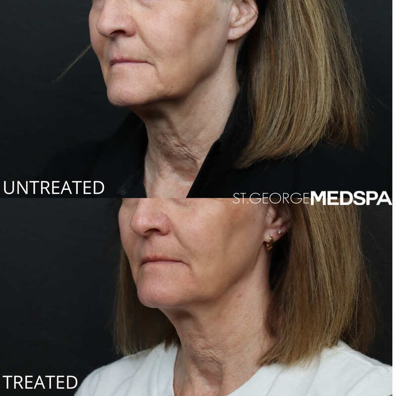 Skin Tightening Before & After Image