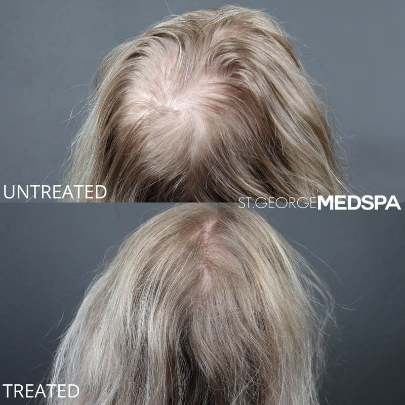 PRF Hair Restoration Before & After Image