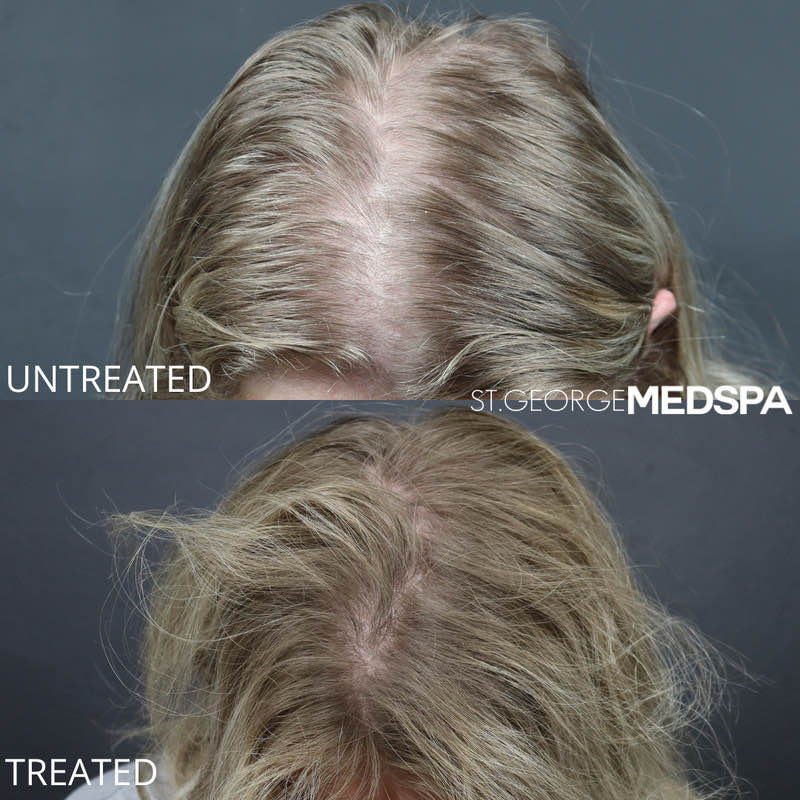 PRF Hair Restoration Before & After Image