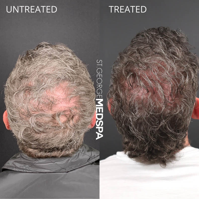 PRF Hair Restoration Before & After Image