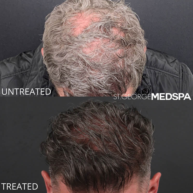 PRF Hair Restoration Before & After Image
