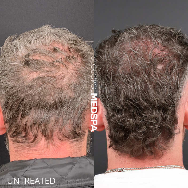 PRF Hair Restoration Before & After Image