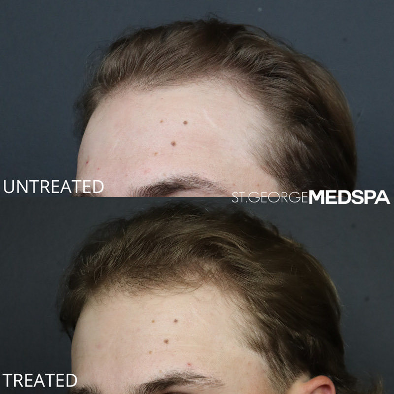 PRF Hair Restoration Before & After Image