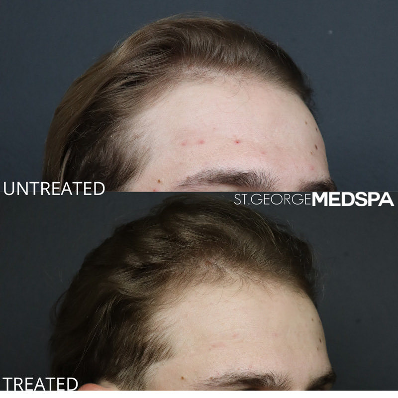 PRF Hair Restoration Before & After Image