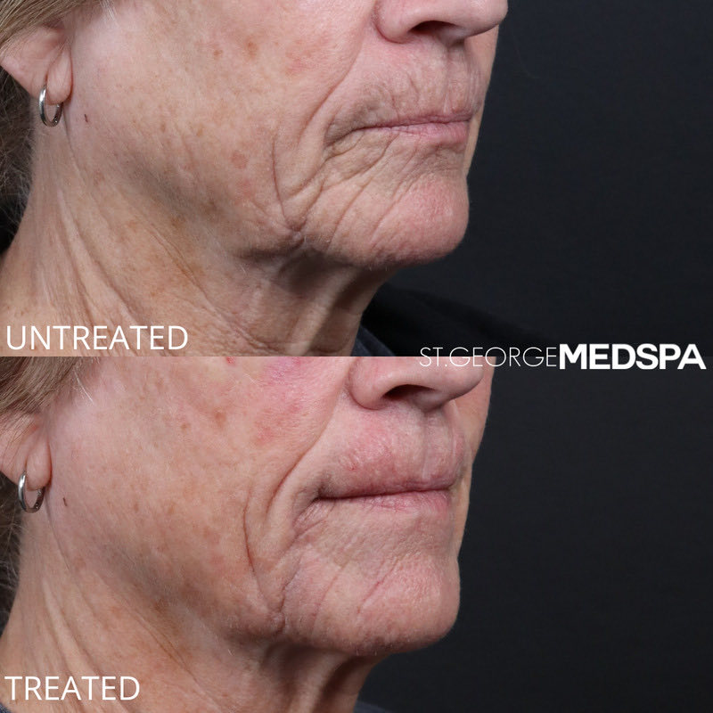 PRF Injections Before & After Image