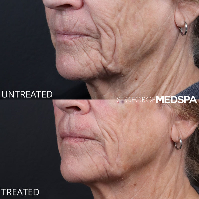 PRF Injections Before & After Image