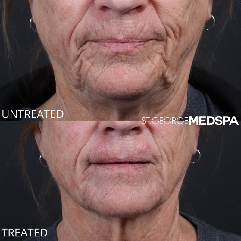 PRF Injections Before & After Image