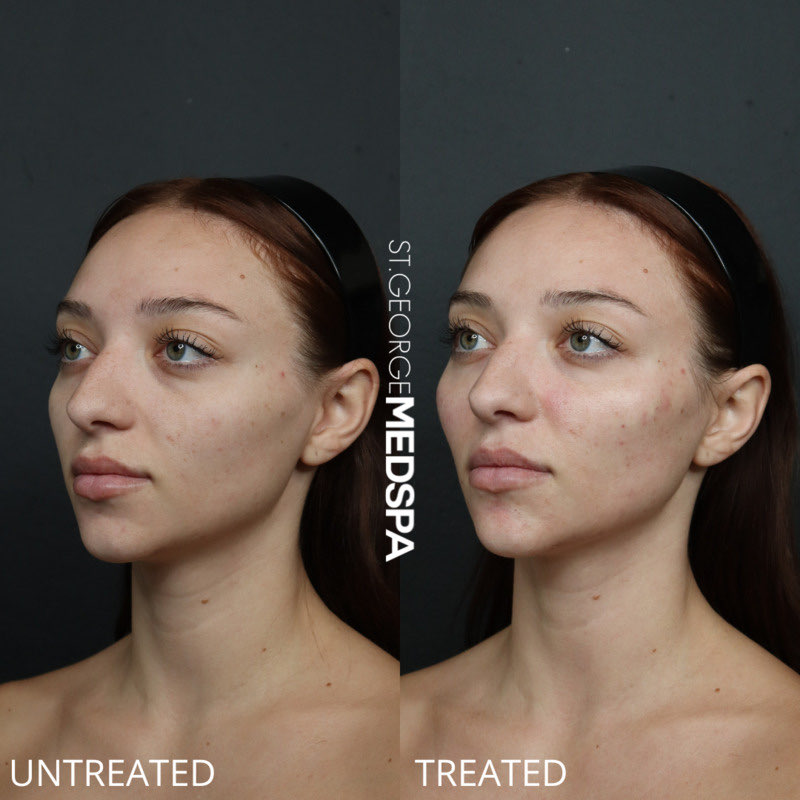 PRF Injections Before & After Image
