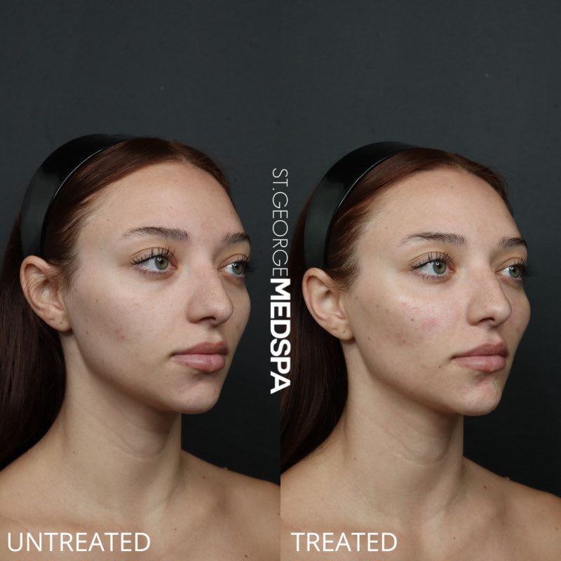 PRF Injections Before & After Image