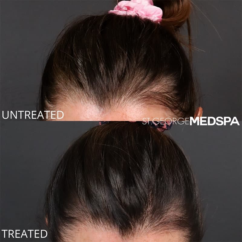 PRP PRF Injections Before & After Image