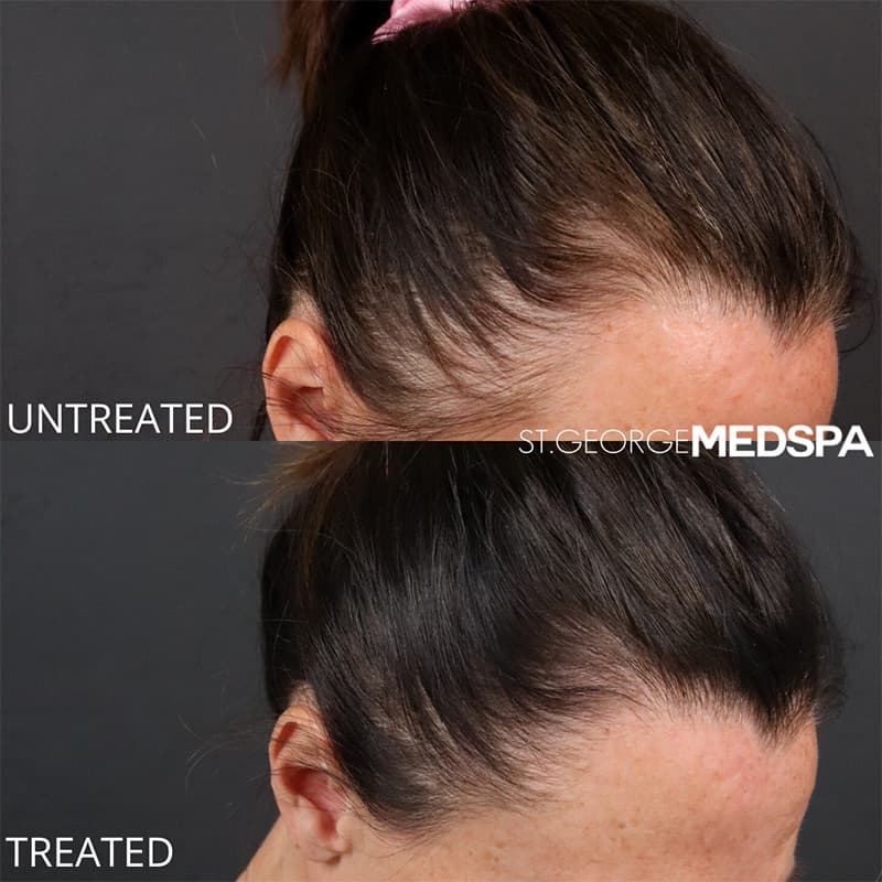 PRP PRF Injections Before & After Image