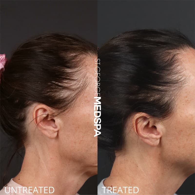 PRP & PRF Injections Before & After Image