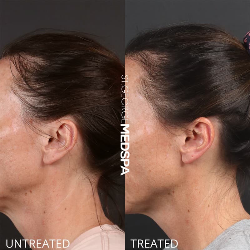 PRP & PRF Injections Before & After Image