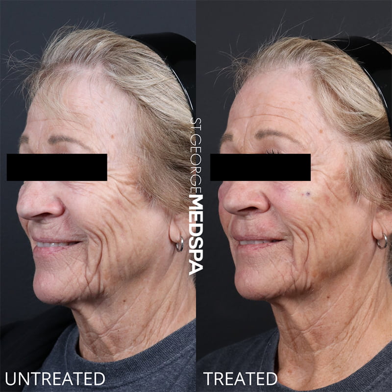 PRP & PRF Injections Before & After Image