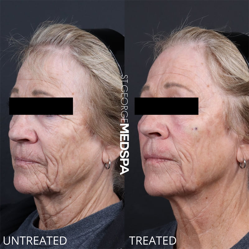 PRP & PRF Injections Before & After Image