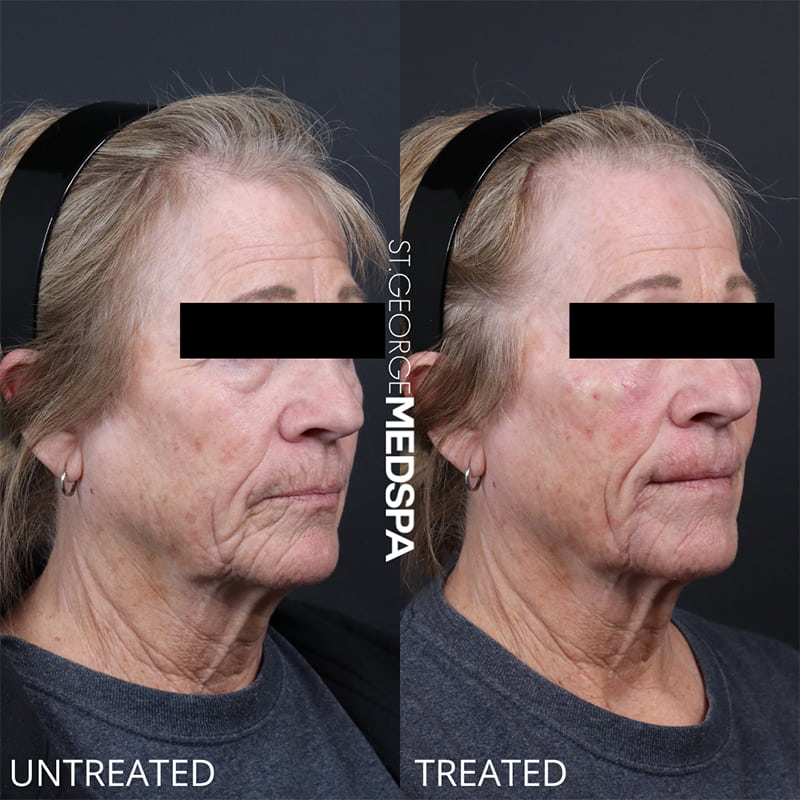 PRP & PRF Injections Before & After Image