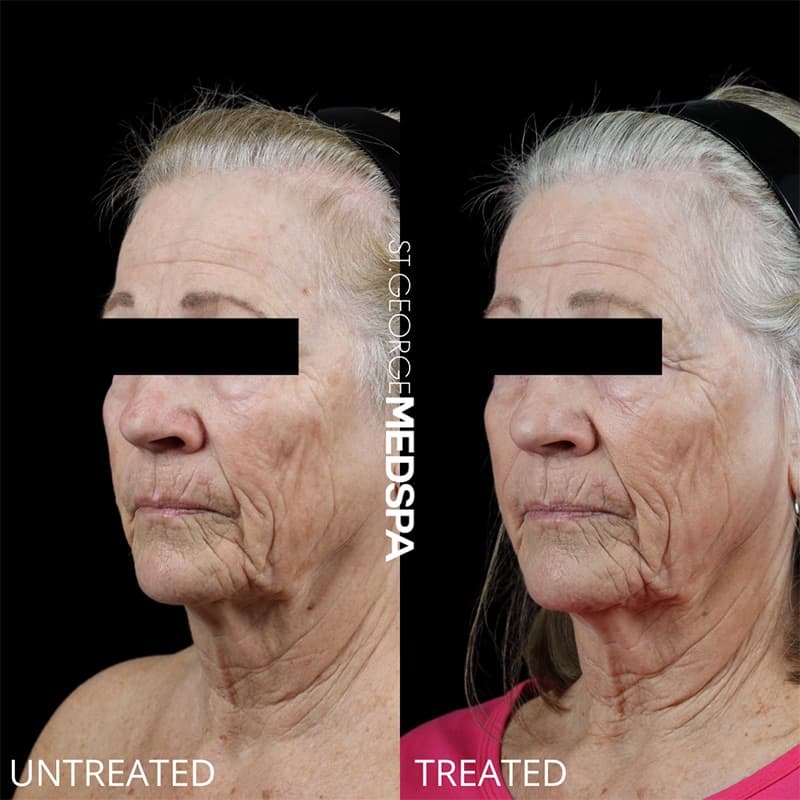 PRP & PRF Injections Before & After Image