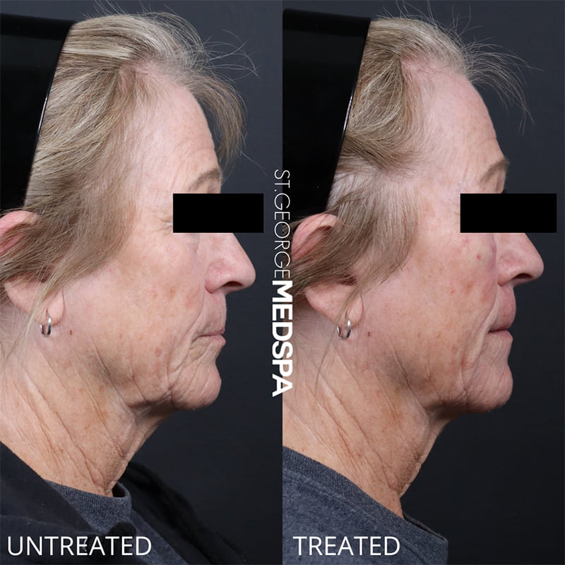 PRP & PRF Injections Before & After Image