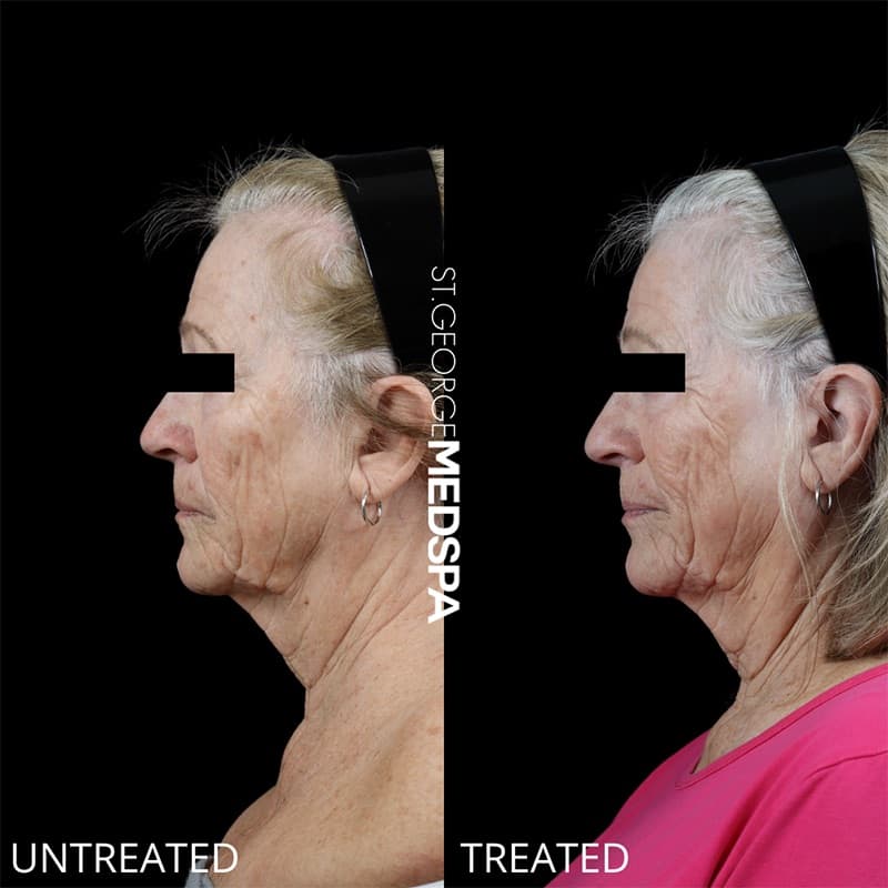PRP & PRF Injections Before & After Image