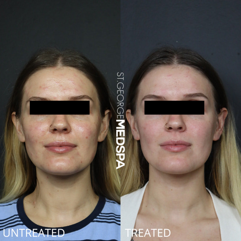 Chemical Peel Before & After Image