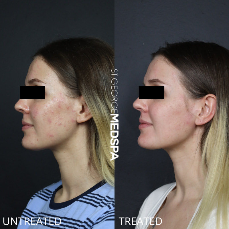 Chemical Peel Before & After Image