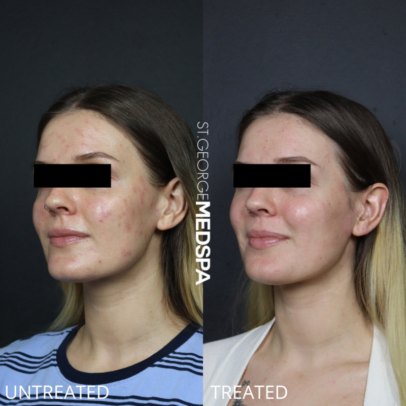 Chemical Peel Before & After Image