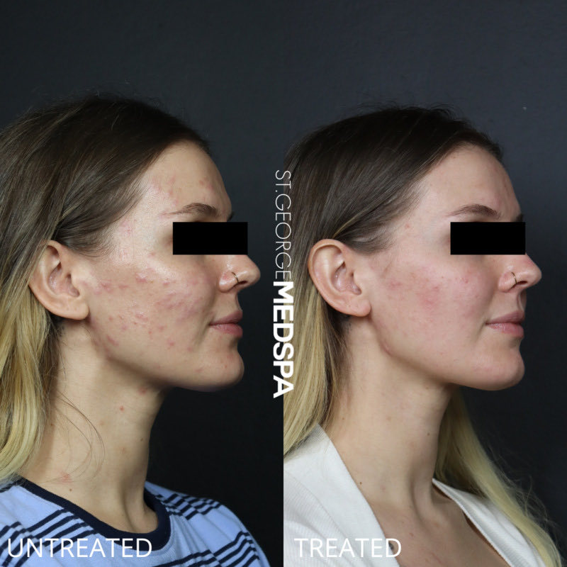 Chemical Peel Before & After Image